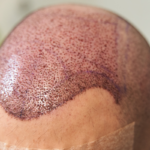 La Tecnica FUE - Un nuovo metodo di Trapianto di capelli