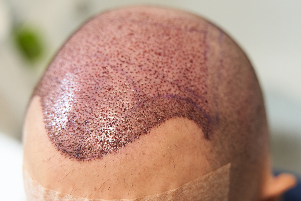 La Tecnica FUE - Un nuovo metodo di Trapianto di capelli