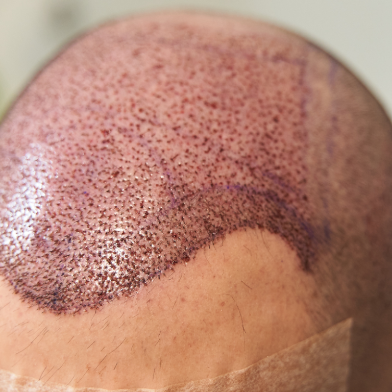 La Tecnica FUE - Un nuovo metodo di Trapianto di capelli